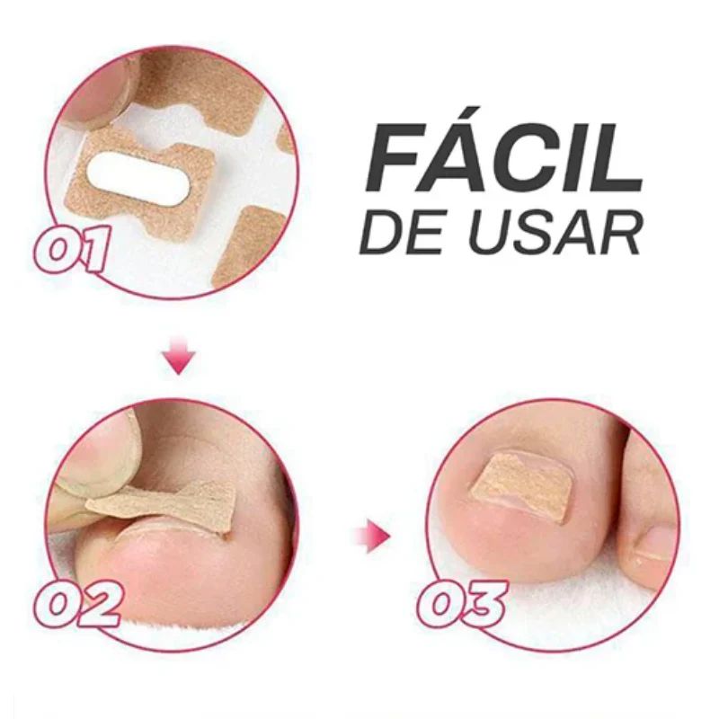 CuraNail™ - PARCHES UÑAS ENCARNADAS ANTIHONGOS