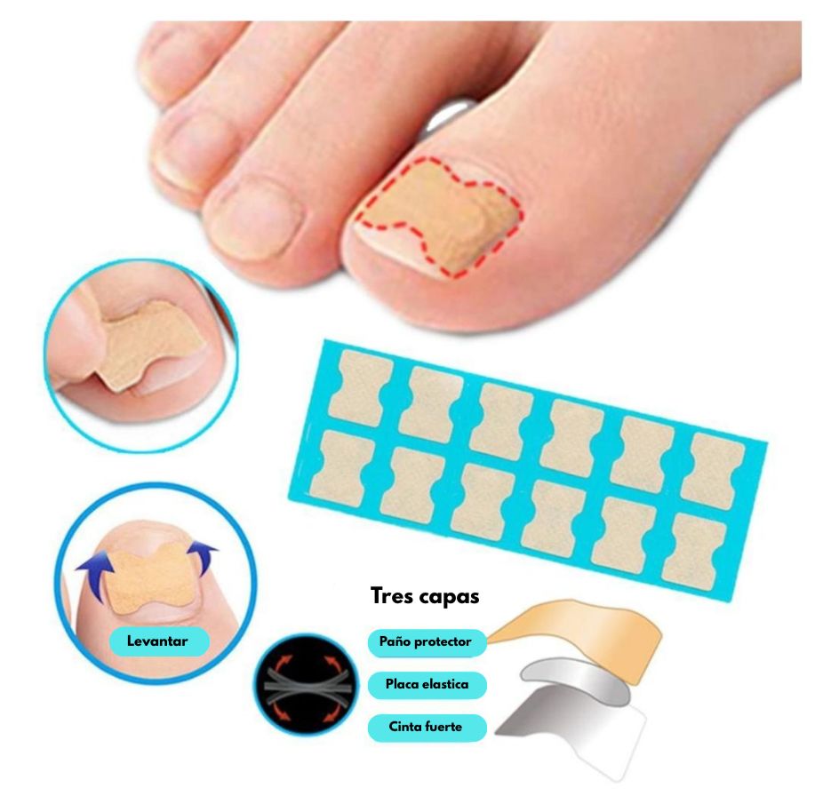 CuraNail™ - PARCHES UÑAS ENCARNADAS ANTIHONGOS