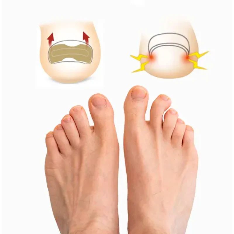 CuraNail™ - PARCHES UÑAS ENCARNADAS ANTIHONGOS