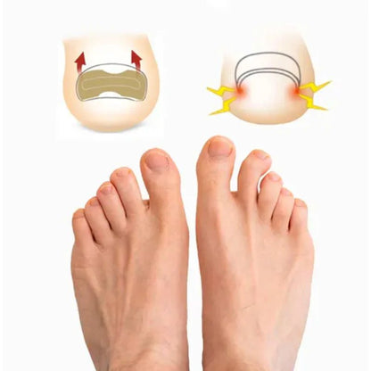 CuraNail™ - PARCHES UÑAS ENCARNADAS ANTIHONGOS